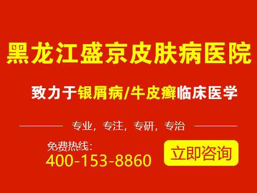 黑龙江盛京银屑病医院专业治疗银屑病